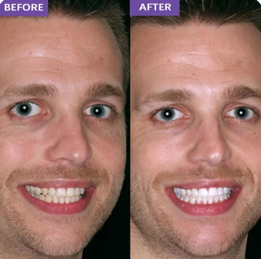 Before and after comparison of a man's smile after Valouré Whitening Strips.