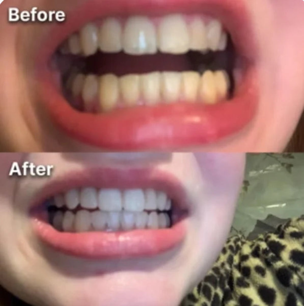 Before and after comparison of teeth.